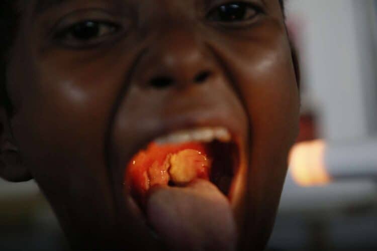 diphtheria cases south africa