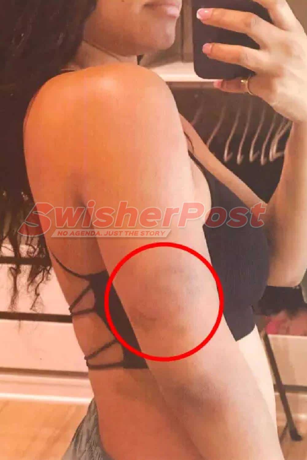 Halle Bailey bruised arm