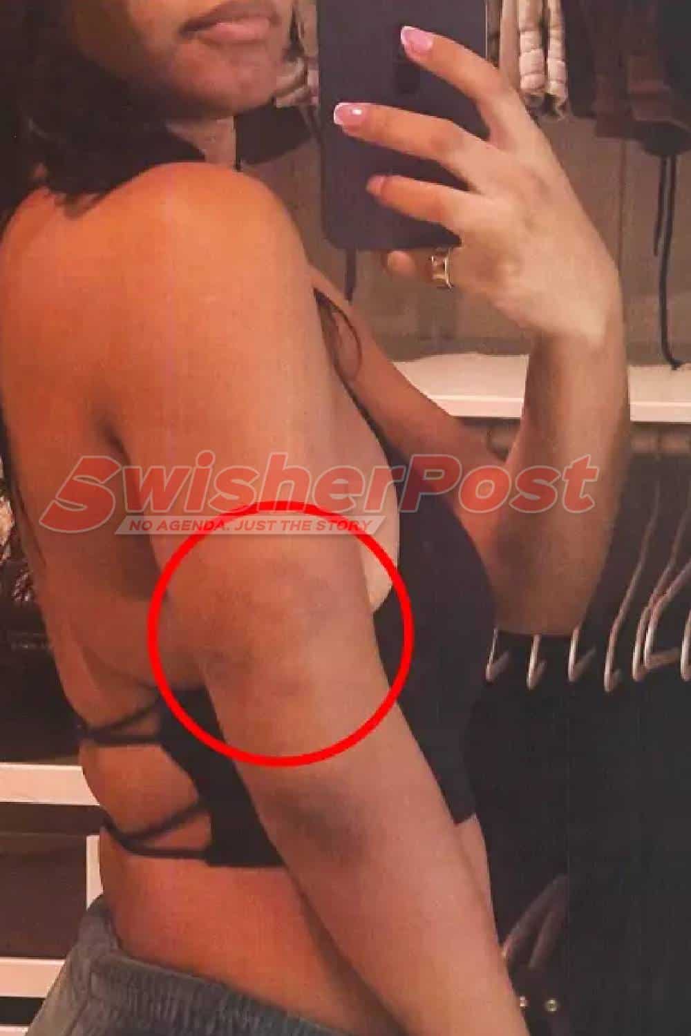 Halle Bailey bruised arm
