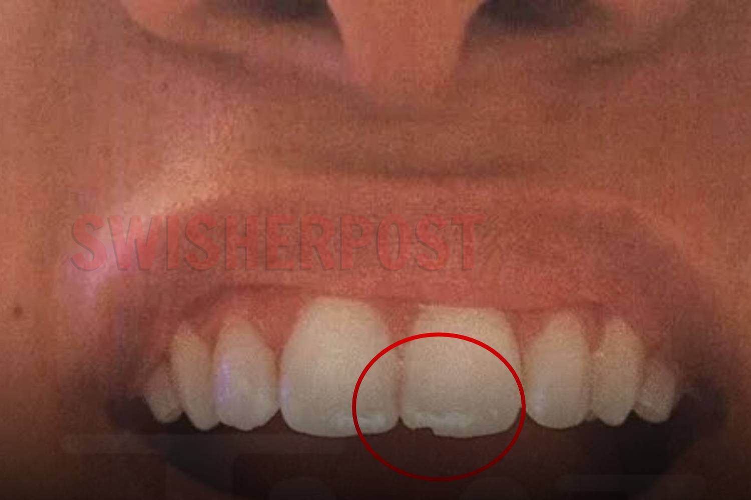 halle bailey chipped tooth