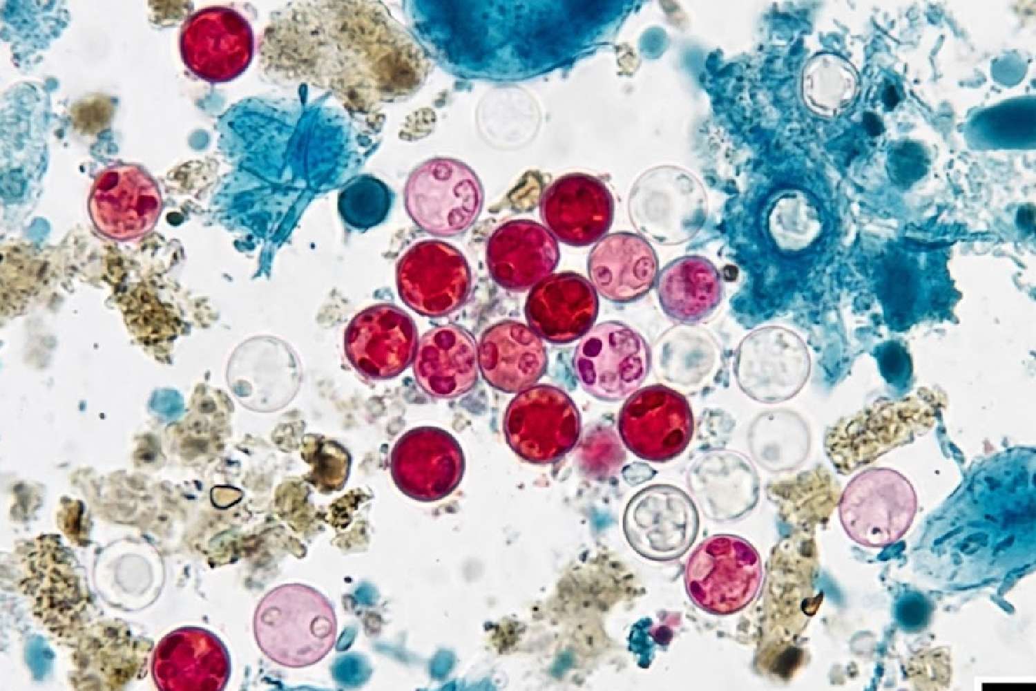 cyclospora outbreak spreads 31 us states